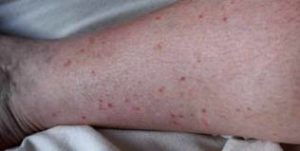 Chikungunya Symptoms in Hindi