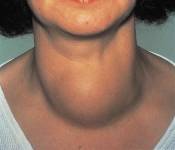 Thyroid Symptoms in Hindi - Goitre Lakshan