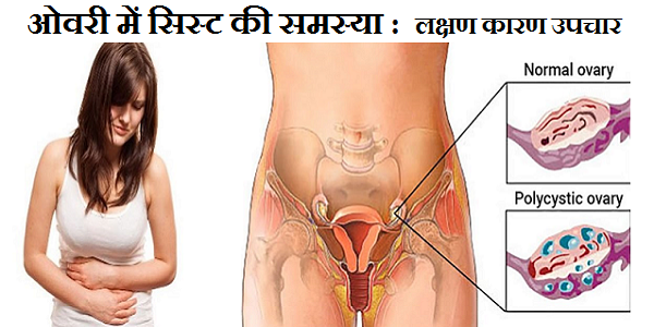 PCOS PCOD in Hindi