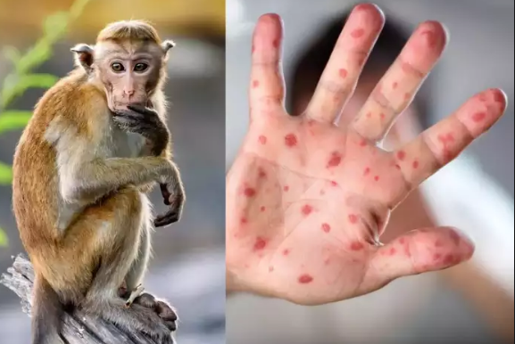 Monkeypox kya hai | Monkeypox virus in hindi